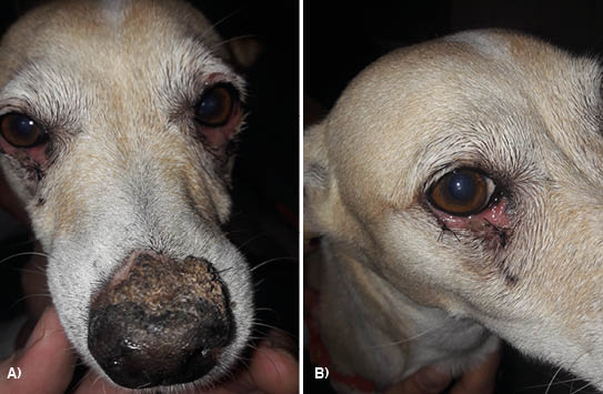 Figura 1: Fotografia dos aspectos das lesões dermatológicas e oftálmicas ocasionadas por Lúpus Eritematoso Discóide. A) Presença de lesões ulceradas e com crostas em região de pálpebras inferiores (direita e esquerda) e plano nasal. B) Pálpebra inferior direita apresentando ulceração, crostas, epífora e presença de ponto cirúrgico após procedimento de biópsia local. Fonte: Arquivo pessoal, 2018.